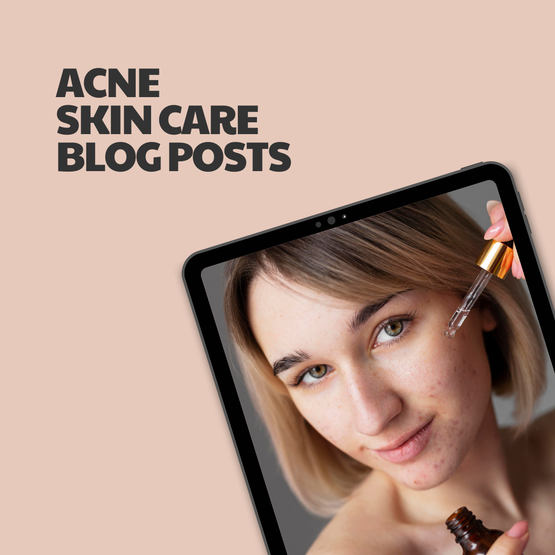 Acne Skin Care – 5 Pre-Written Articles